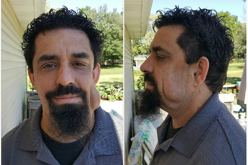 Fundraiser by Onasis Strz Neurofibromatosis Fighter