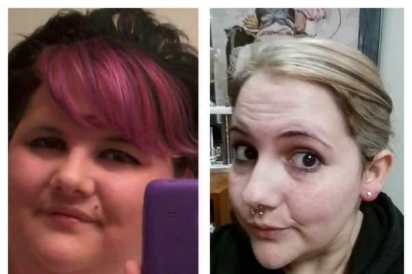 Fundraiser by Abby Normal Excess Skin removal Surgery